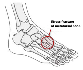 Why are the feet prone to stress fractures