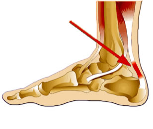 Achilles Tendonitis is painful for runners