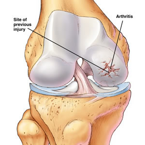 osteoarthritis in the knee effects female farmers at a high rate