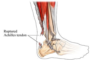 Tendon Injuries are a common injury that farmers face