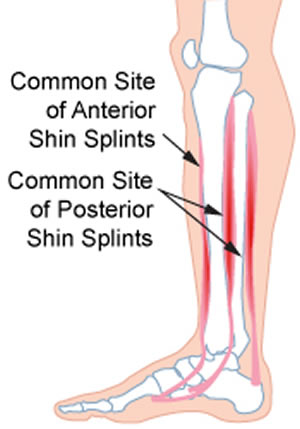 Shin Splints will make running painful