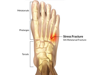 Dont let a stress fracture take you out of the race