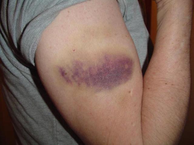 Bruises are common injuries that occur from horseback riding