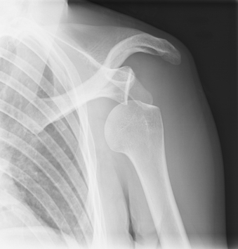Dislocated Shoulder is a common injury from horseback riding