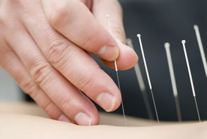 acupuncture can aid lupus pain
