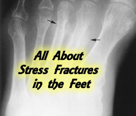 all-about-stress-fractures-feet