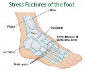what-is-a-stress-fracture