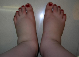 swollen-feet-pregnant